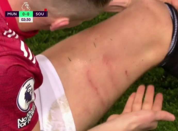 Scott McTominay's leg after awful challenge in Man United vs Southampton