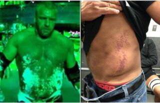 Triple H suffers bad burns