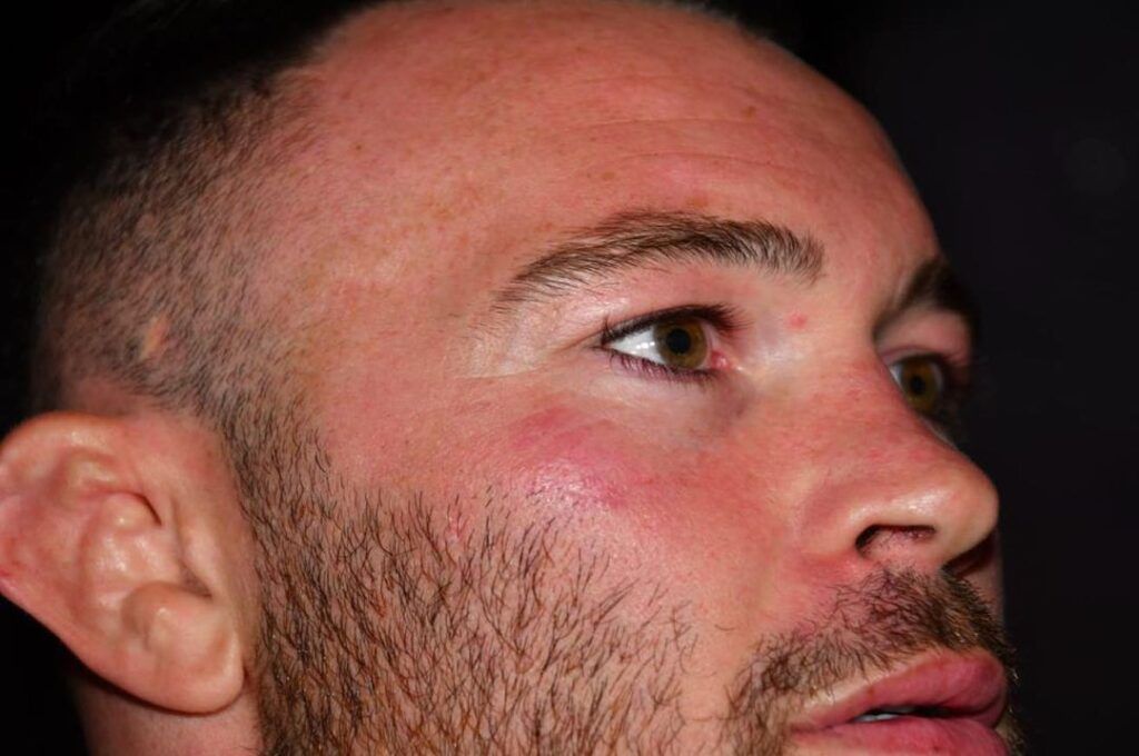colby-covington-bruised-face-alleged-attack