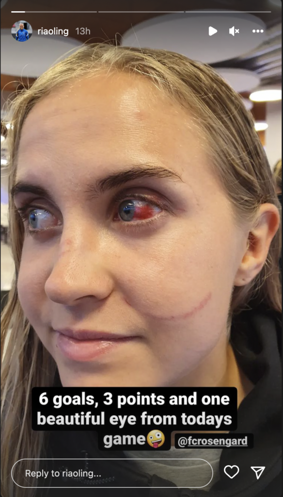 Finnish footballer Ria Öling's eye injury