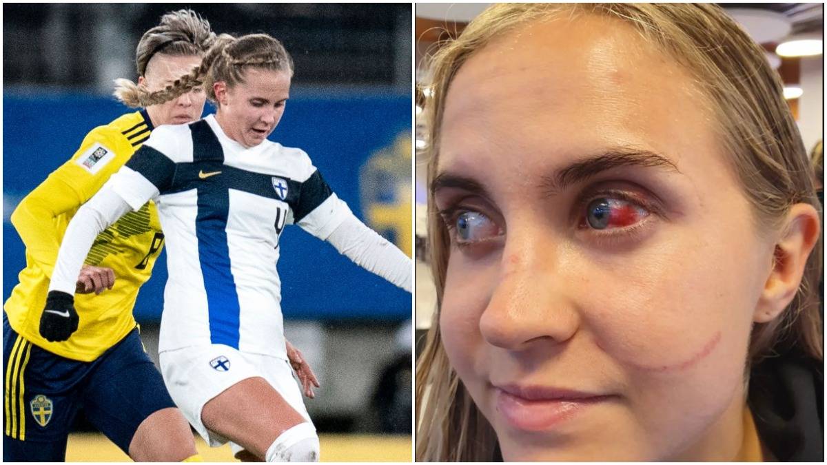 Finnish footballer Ria Öling's eye injury