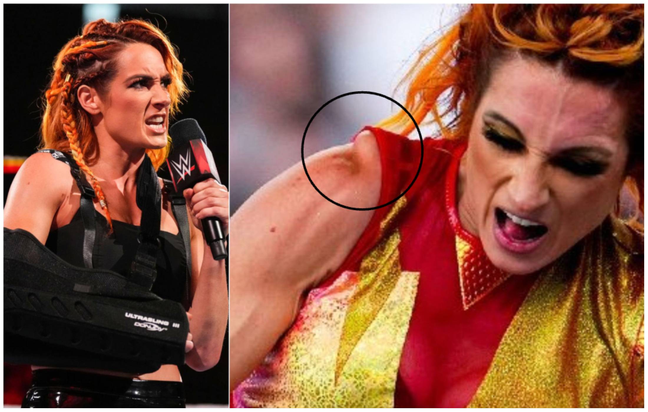 Becky Lynch injured her shoulder at WWE SummerSlam